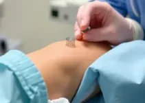 Mutirão de inserção de Implanon em Americana